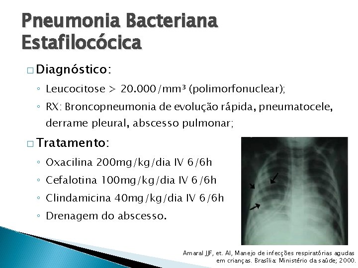 Pneumonia Bacteriana Estafilocócica � Diagnóstico: ◦ Leucocitose > 20. 000/mm³ (polimorfonuclear); ◦ RX: Broncopneumonia