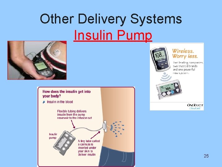 Other Delivery Systems Insulin Pump 25 