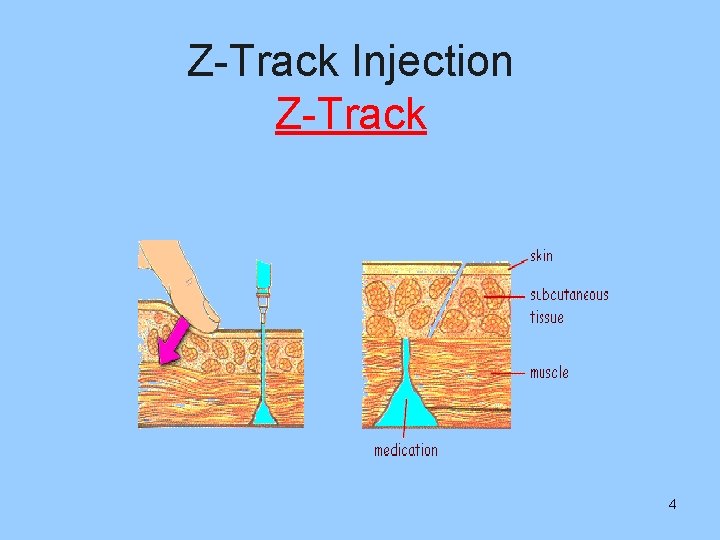 Z-Track Injection Z-Track 4 