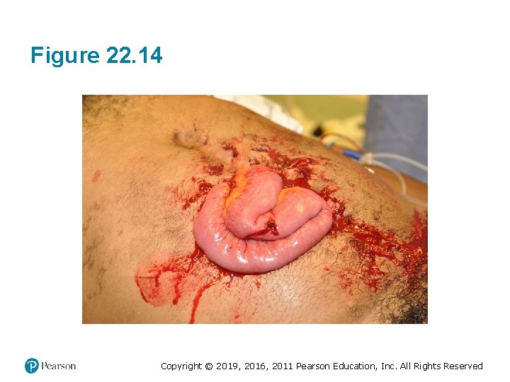 Figure 22. 14 Copyright © 2019, 2016, 2011 Pearson Education, Inc. All Rights Reserved Figure 22. 14 Copyright © 2019, 2016, 2011 Pearson Education, Inc. All Rights Reserved