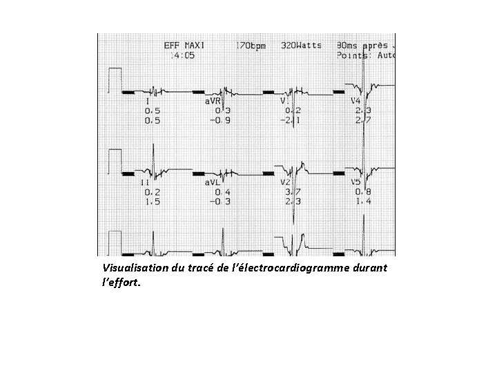 Visualisation du tracé de l’électrocardiogramme durant l’effort. 