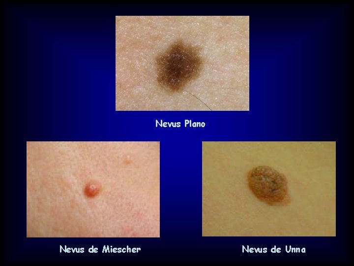 Nevus Plano Nevus de Miescher Nevus de Unna 