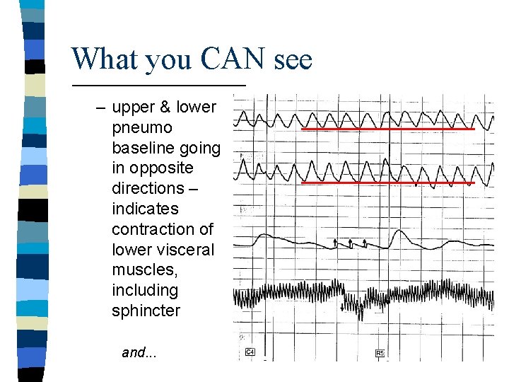 What you CAN see – upper & lower pneumo baseline going in opposite directions