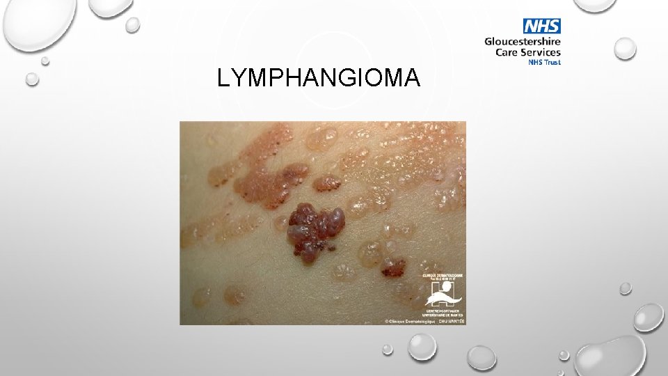 LYMPHANGIOMA 