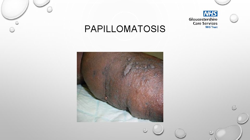 PAPILLOMATOSIS 