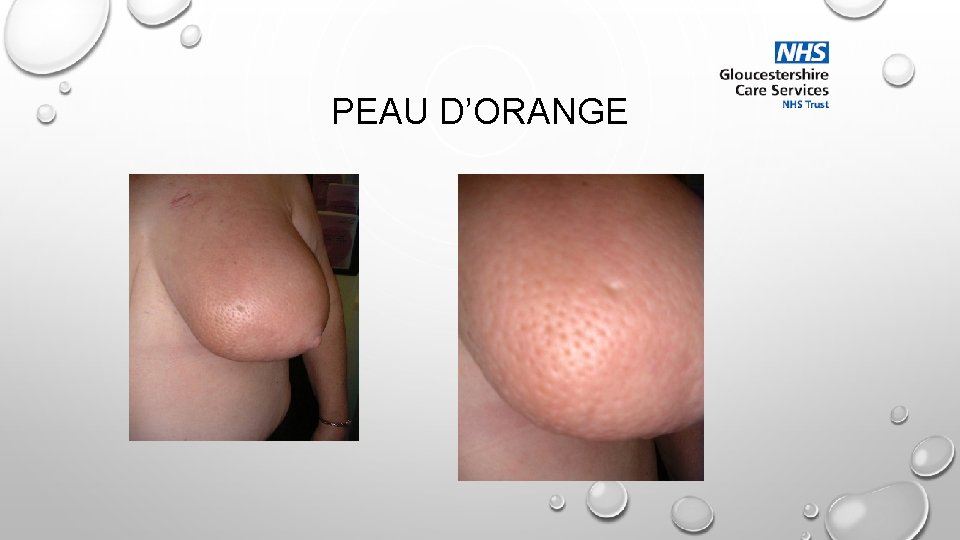 PEAU D’ORANGE 