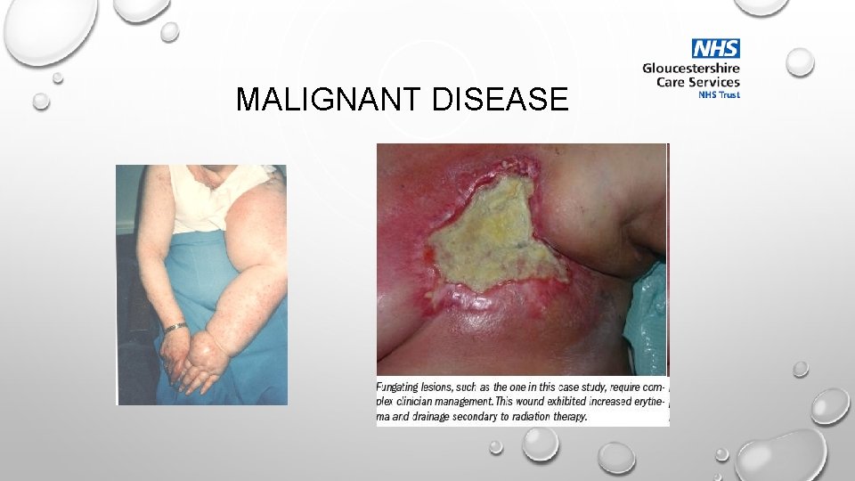 MALIGNANT DISEASE 