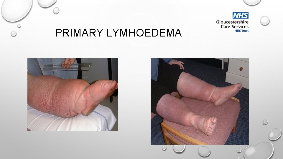 PRIMARY LYMHOEDEMA 