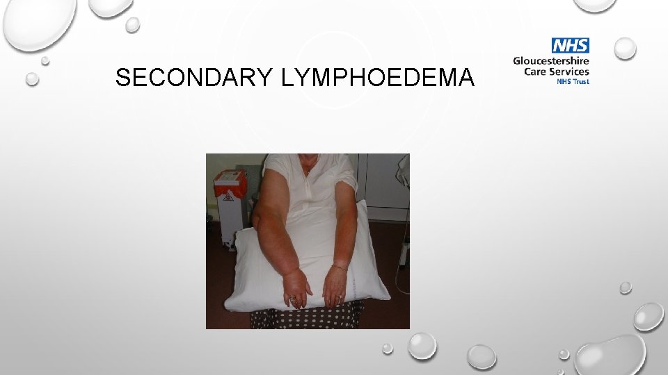 SECONDARY LYMPHOEDEMA 