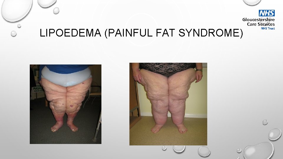 LIPOEDEMA (PAINFUL FAT SYNDROME) 