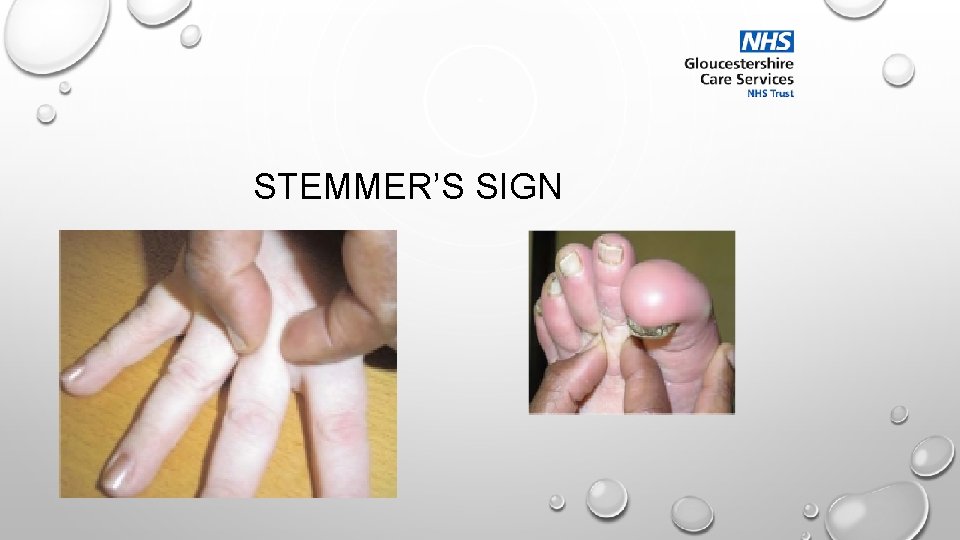 STEMMER’S SIGN 