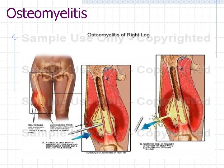Osteomyelitis 