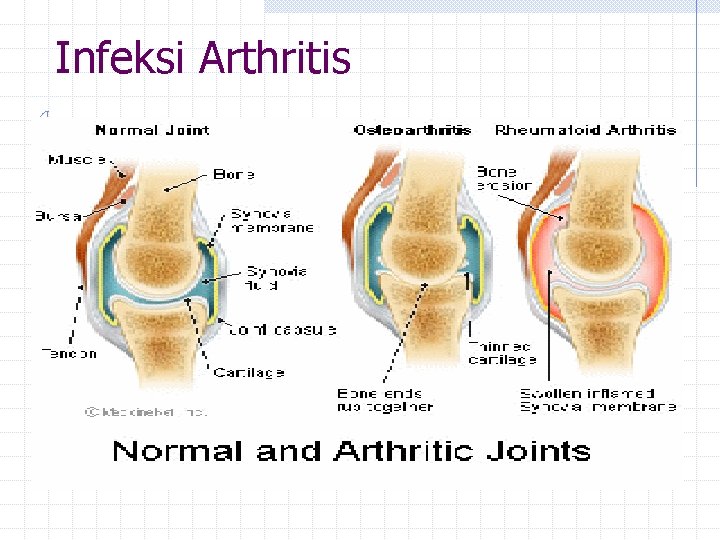 Infeksi Arthritis 