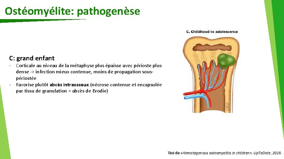 Ostéomyélite: pathogenèse C: grand enfant - Corticale au niveau de la métaphyse plus épaisse