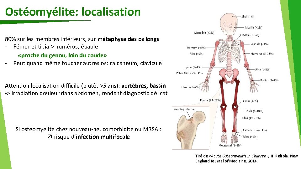 Ostéomyélite: localisation 80% sur les membres inférieurs, sur métaphyse des os longs - Fémur