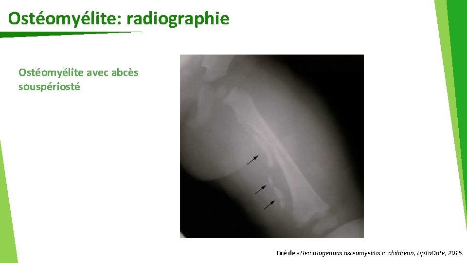 Ostéomyélite: radiographie Ostéomyélite avec abcès souspériosté Tiré de «Hematogenous osteomyelitis in children» , Up.