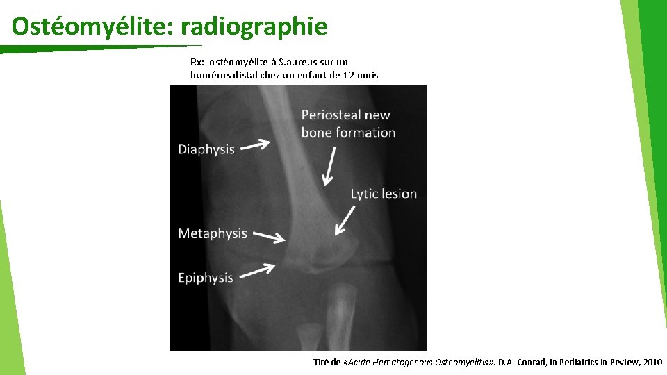 Ostéomyélite: radiographie Rx: ostéomyélite à S. aureus sur un humérus distal chez un enfant