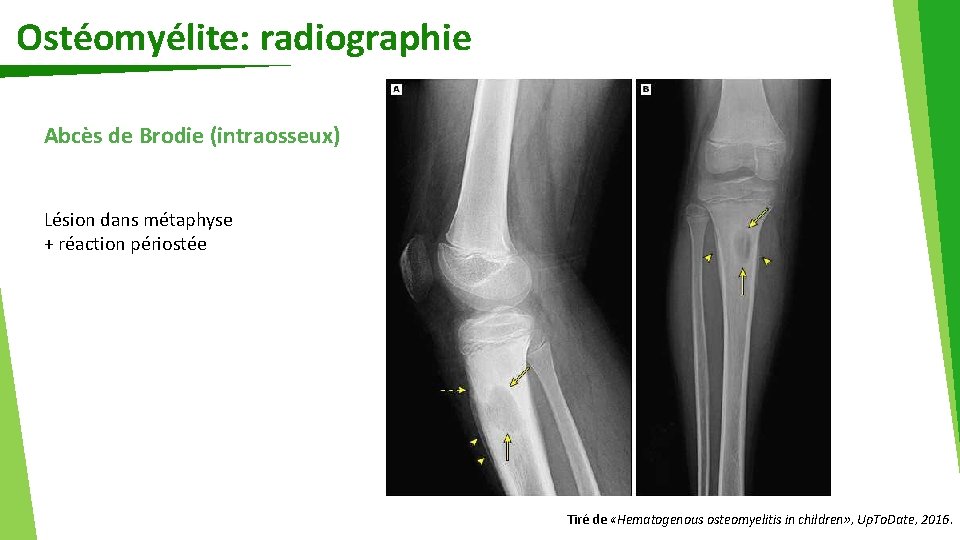 Ostéomyélite: radiographie Abcès de Brodie (intraosseux) Lésion dans métaphyse + réaction périostée Tiré de