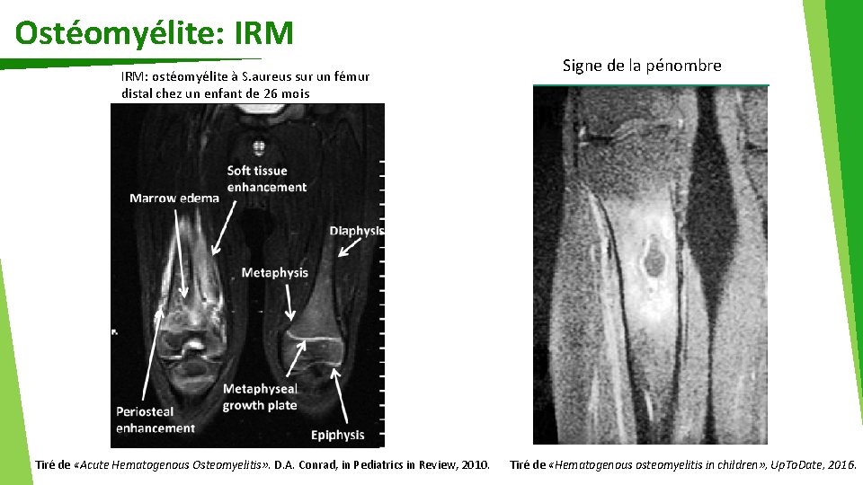 Ostéomyélite: IRM: ostéomyélite à S. aureus sur un fémur distal chez un enfant de