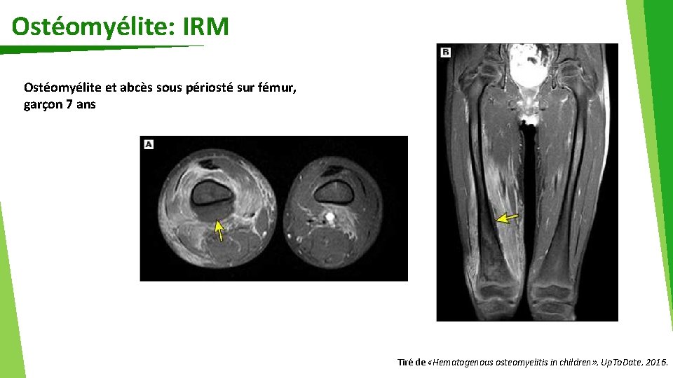 Ostéomyélite: IRM Ostéomyélite et abcès sous périosté sur fémur, garçon 7 ans Tiré de