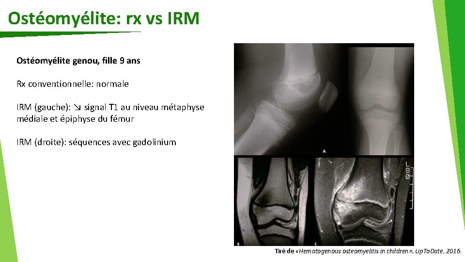 Ostéomyélite: rx vs IRM Ostéomyélite genou, fille 9 ans Rx conventionnelle: normale IRM (gauche):