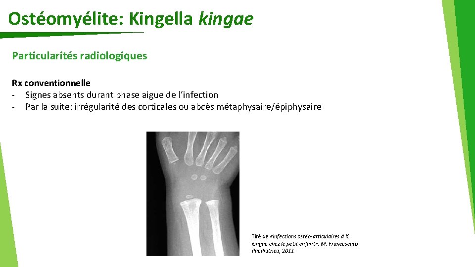 Ostéomyélite: Kingella kingae Particularités radiologiques Rx conventionnelle - Signes absents durant phase aigue de