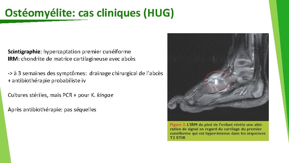 Ostéomyélite: cas cliniques (HUG) Scintigraphie: hypercaptation premier cunéiforme IRM: chondrite de matrice cartilagineuse avec