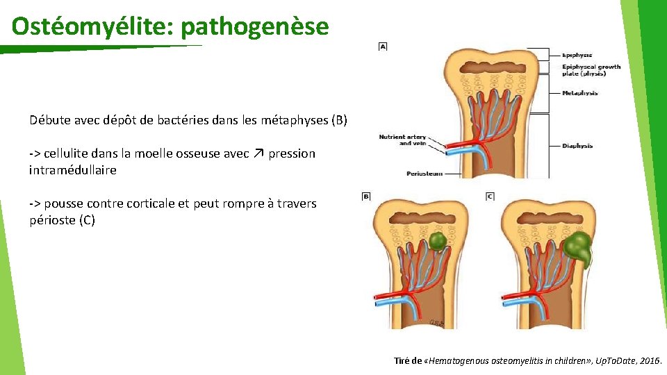 Ostéomyélite: pathogenèse Débute avec dépôt de bactéries dans les métaphyses (B) -> cellulite dans