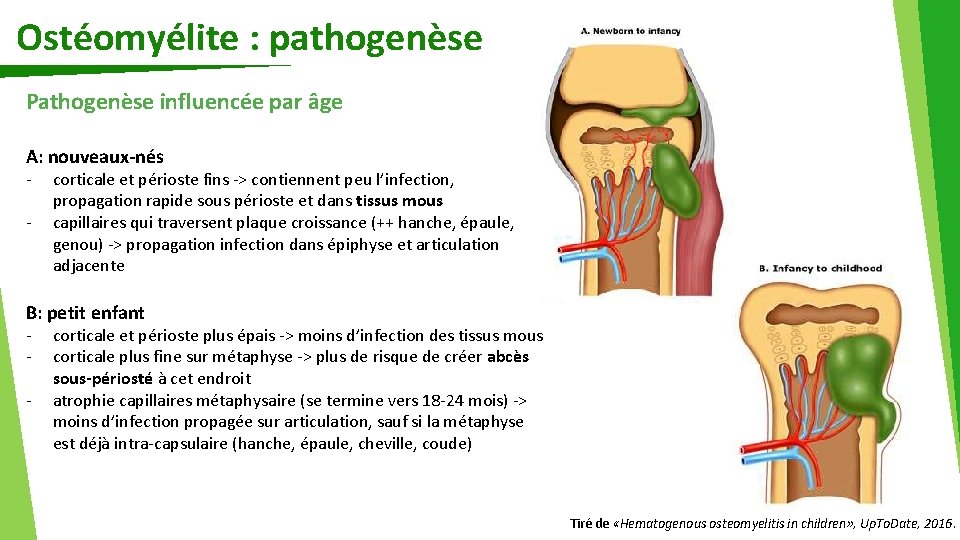 Ostéomyélite : pathogenèse Pathogenèse influencée par âge A: nouveaux-nés - corticale et périoste fins