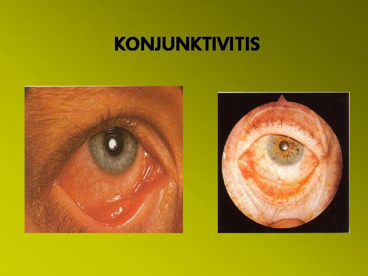 KONJUNKTIVITIS 