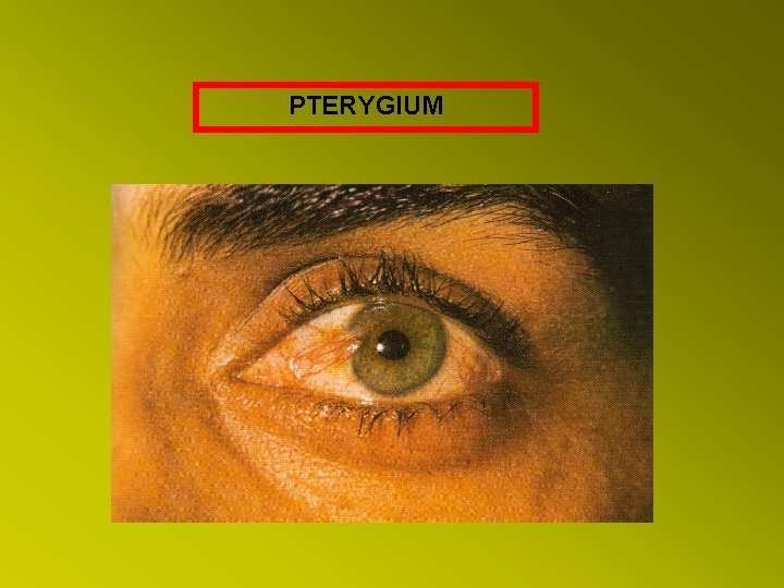 PTERYGIUM 