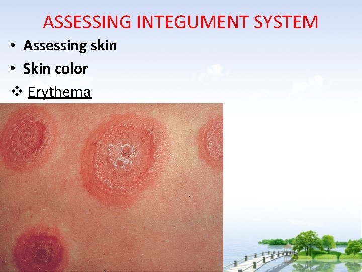 ASSESSING INTEGUMENT SYSTEM • Assessing skin • Skin color v Erythema 