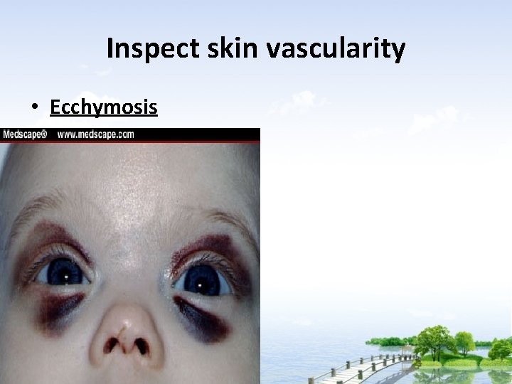 Inspect skin vascularity • Ecchymosis 