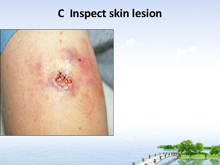 C Inspect skin lesion 