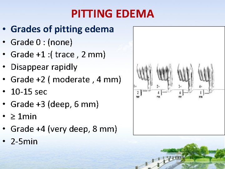 PITTING EDEMA • Grades of pitting edema • • • Grade 0 : (none)