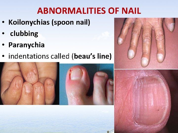 ABNORMALITIES OF NAIL • • Koilonychias (spoon nail) clubbing Paranychia indentations called (beau’s line)