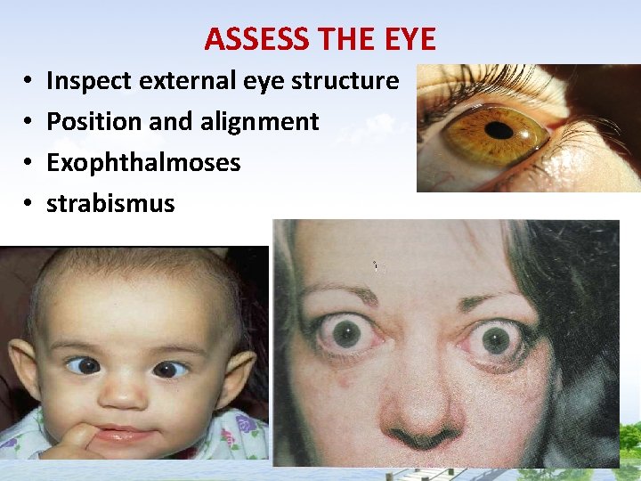 ASSESS THE EYE • • Inspect external eye structure Position and alignment Exophthalmoses strabismus