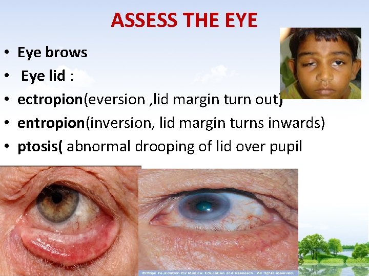 ASSESS THE EYE • • • Eye brows Eye lid : ectropion(eversion , lid