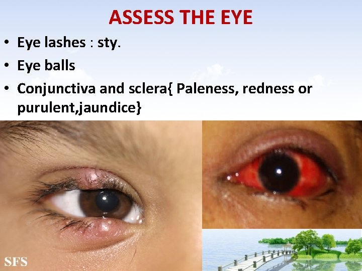 ASSESS THE EYE • Eye lashes : sty. • Eye balls • Conjunctiva and