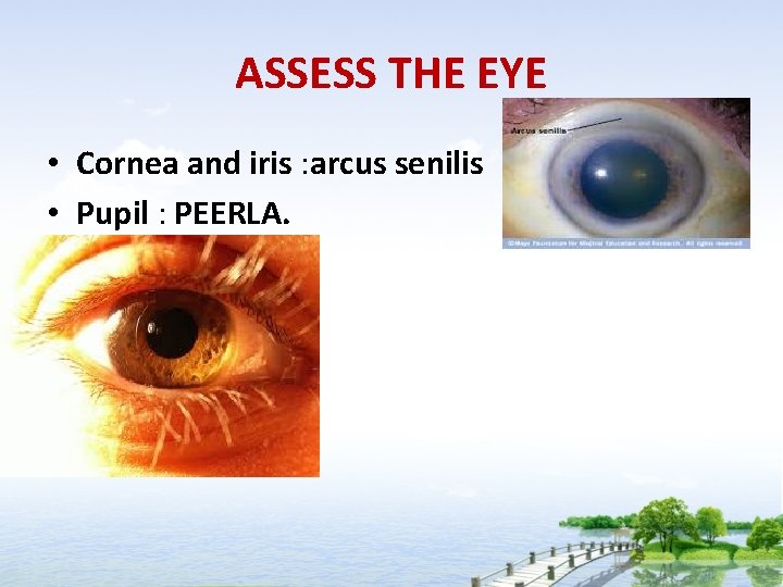 ASSESS THE EYE • Cornea and iris : arcus senilis • Pupil : PEERLA.