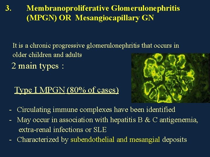 3. Membranoproliferative Glomerulonephritis (MPGN) OR Mesangiocapillary GN It is a chronic progressive glomerulonephritis that