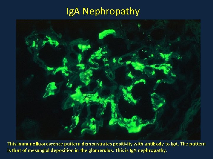 Ig. A Nephropathy This immunofluorescence pattern demonstrates positivity with antibody to Ig. A. The