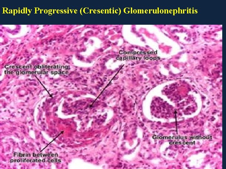 Rapidly Progressive (Cresentic) Glomerulonephritis 