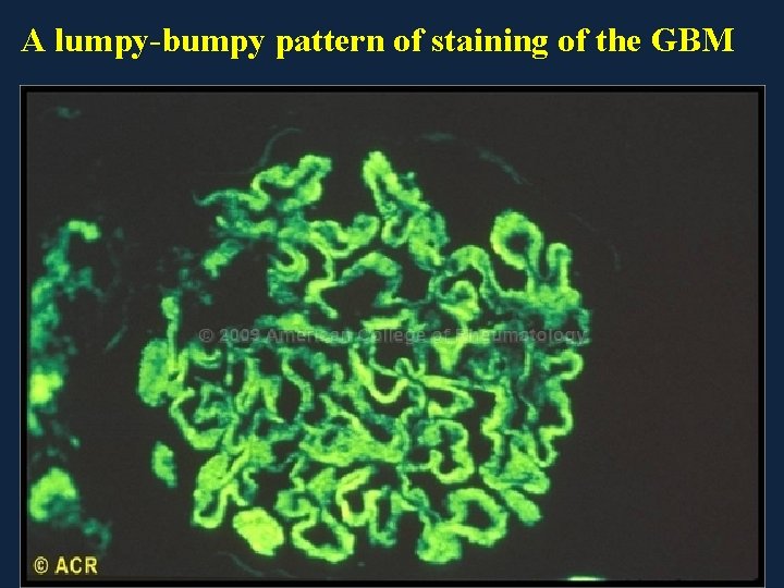 A lumpy-bumpy pattern of staining of the GBM 