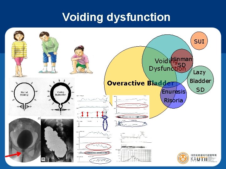 Voiding dysfunction SUI Hinman Voiding SD Dysfunction Overactive Bladder Enuresis Risoria Lazy Bladder SD