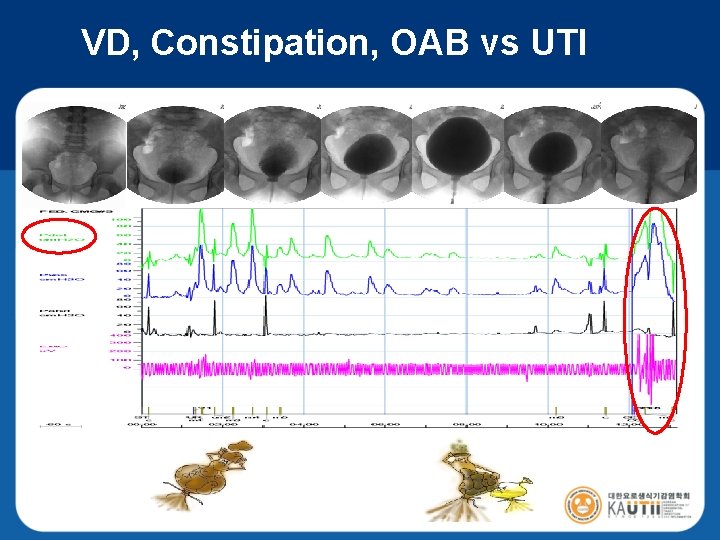 VD, Constipation, OAB vs UTI 