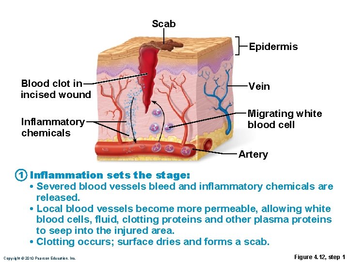 Scab Epidermis Blood clot in incised wound Inflammatory chemicals Vein Migrating white blood cell Scab Epidermis Blood clot in incised wound Inflammatory chemicals Vein Migrating white blood cell