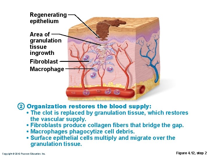 Regenerating epithelium Area of granulation tissue ingrowth Fibroblast Macrophage 2 Organization restores the blood Regenerating epithelium Area of granulation tissue ingrowth Fibroblast Macrophage 2 Organization restores the blood