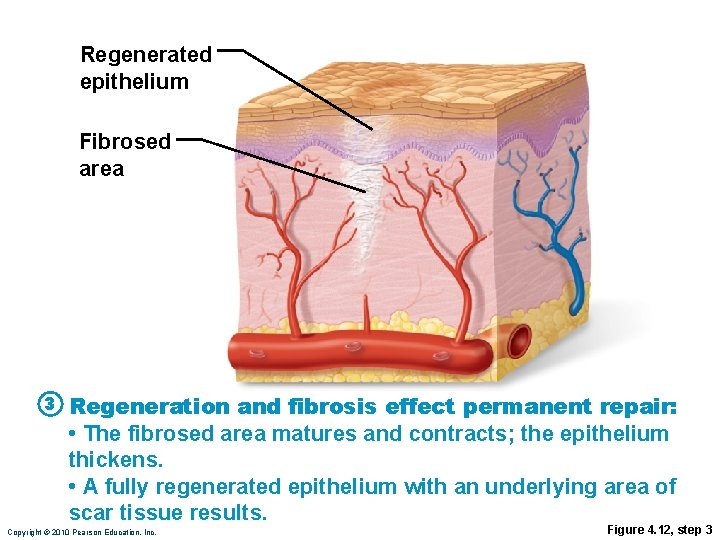 Regenerated epithelium Fibrosed area 3 Regeneration and fibrosis effect permanent repair: • The fibrosed Regenerated epithelium Fibrosed area 3 Regeneration and fibrosis effect permanent repair: • The fibrosed