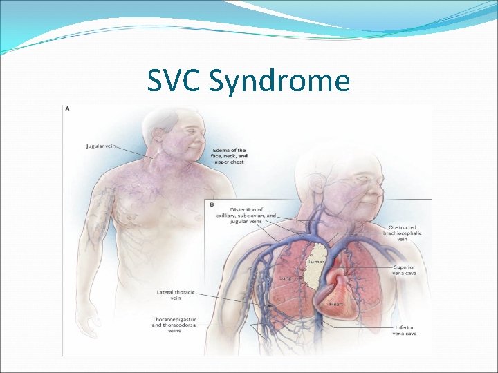 SVC Syndrome 